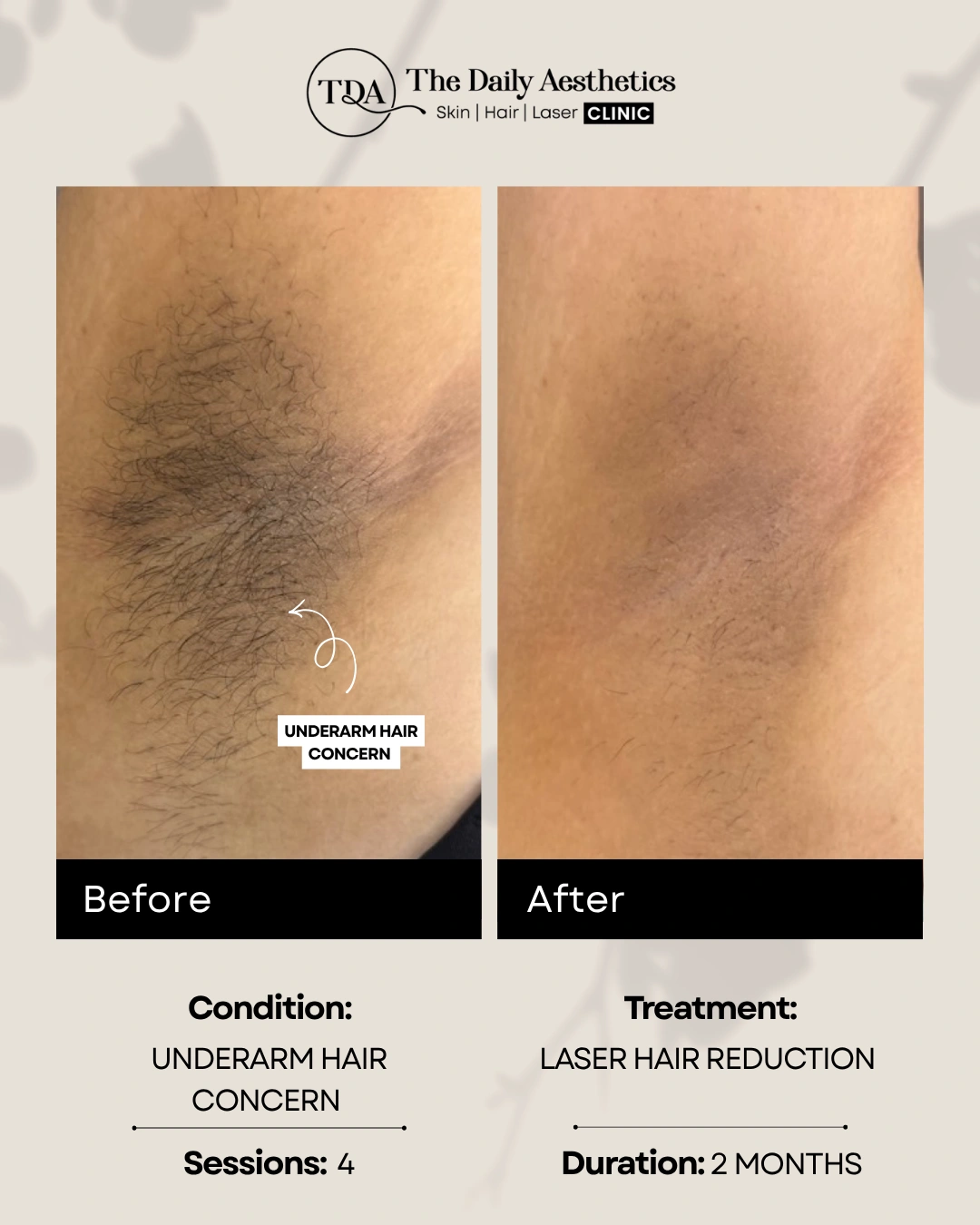 Underarm Hair Concern (Laser Hair Reduction Treatment)