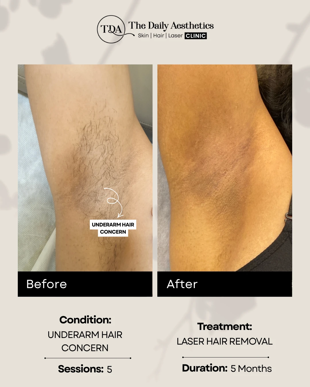 Underarm Hair Concern (Laser Hair Removal Treatment) (2)