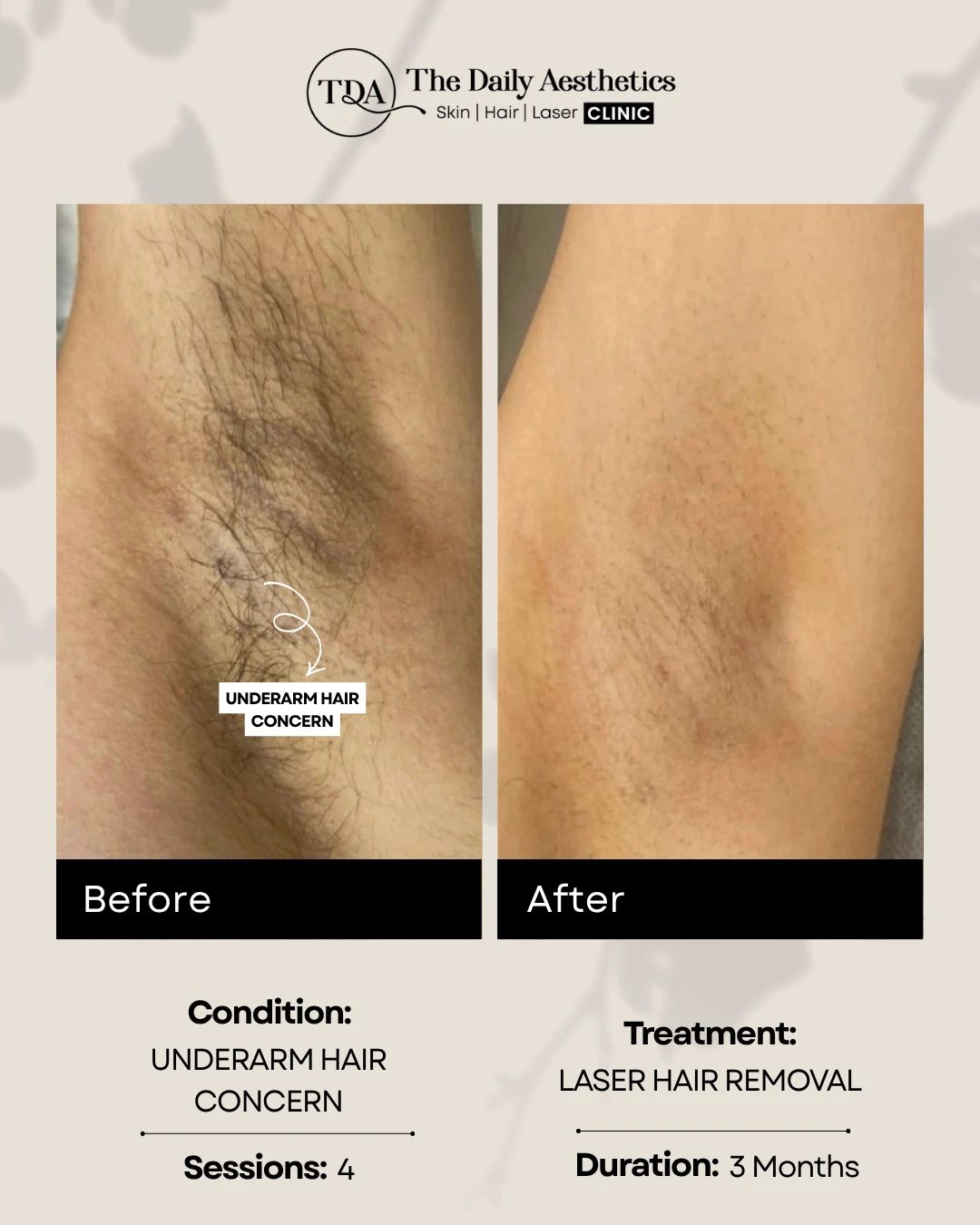 Underarm Hair Concern (Laser Hair Removal Treatment)