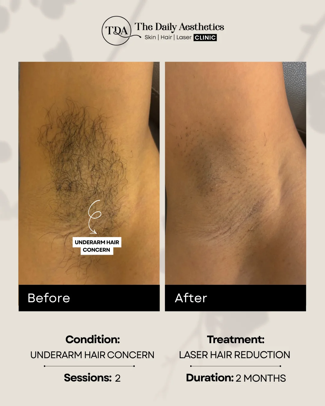 Underarm Hair Concern (Laser Hair Removal)