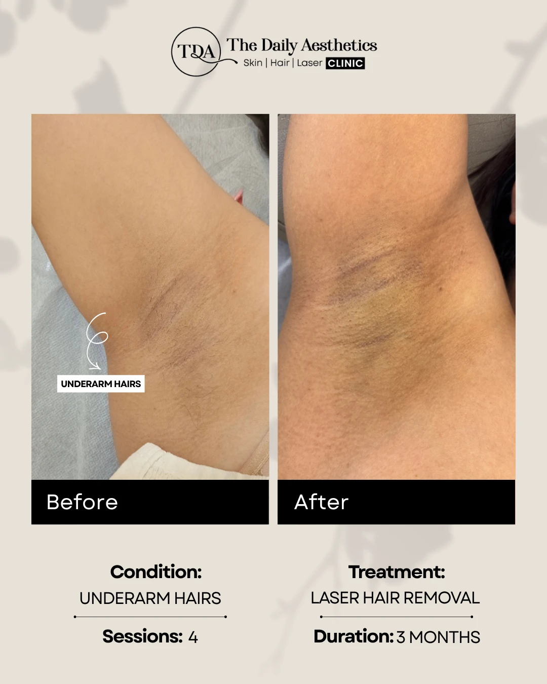 Underarm Hairs (Laser Hair Removal Treatment) (2)
