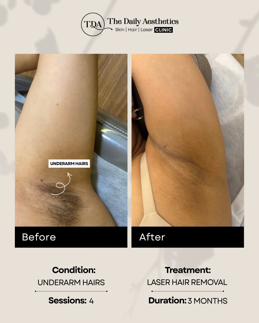 Underarm Hairs (Laser Hair Removal Treatment)