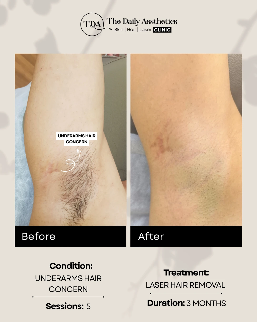 Underarms Hair Concern (Laser Hair Removal Treatment) (2)