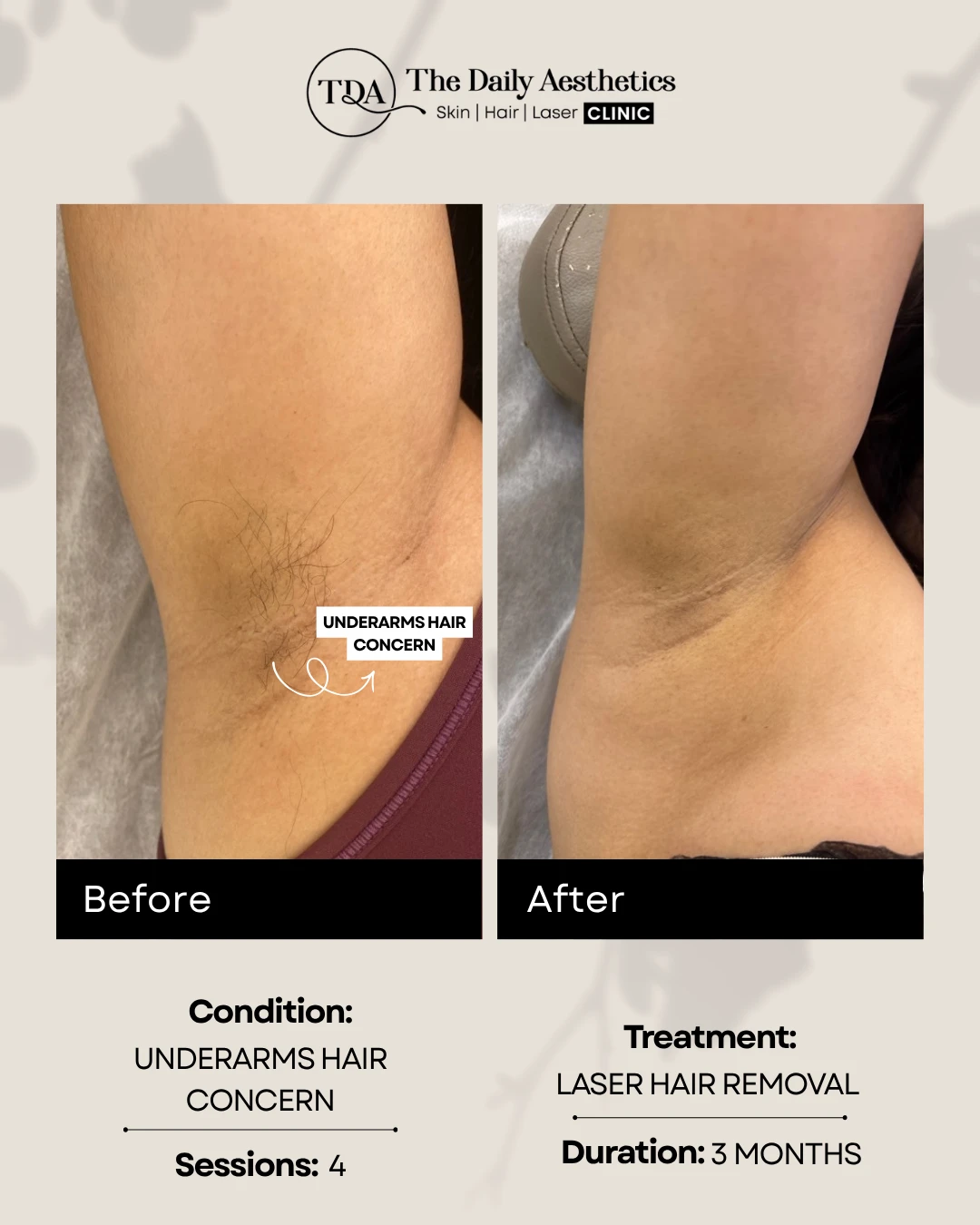 Underarms Hair Concern (Laser Hair Removal Treatment) (3)