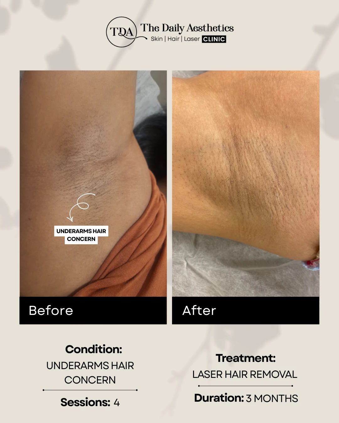 Underarms Hair Concern (Laser Hair Removal Treatment) (4)