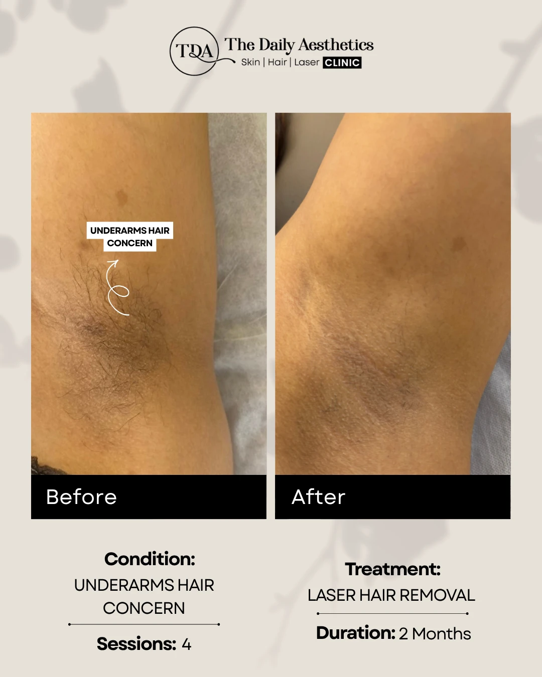 Underarms Hair Concern (Laser Hair Removal Treatment)