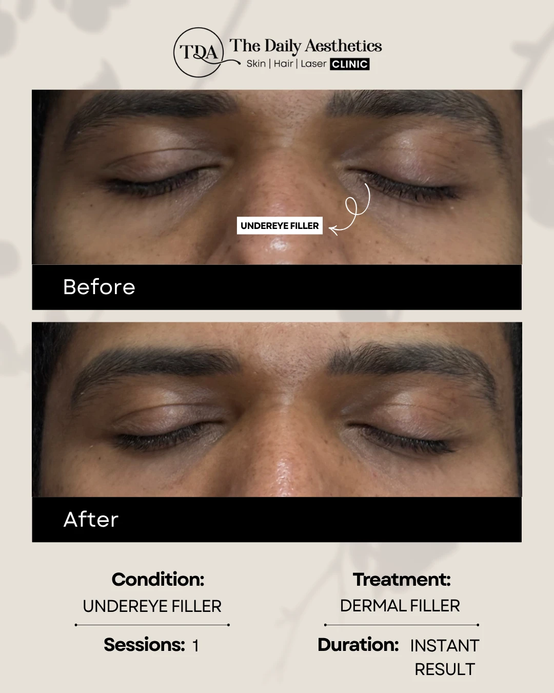 Undereye Filler (Dermal Filler)