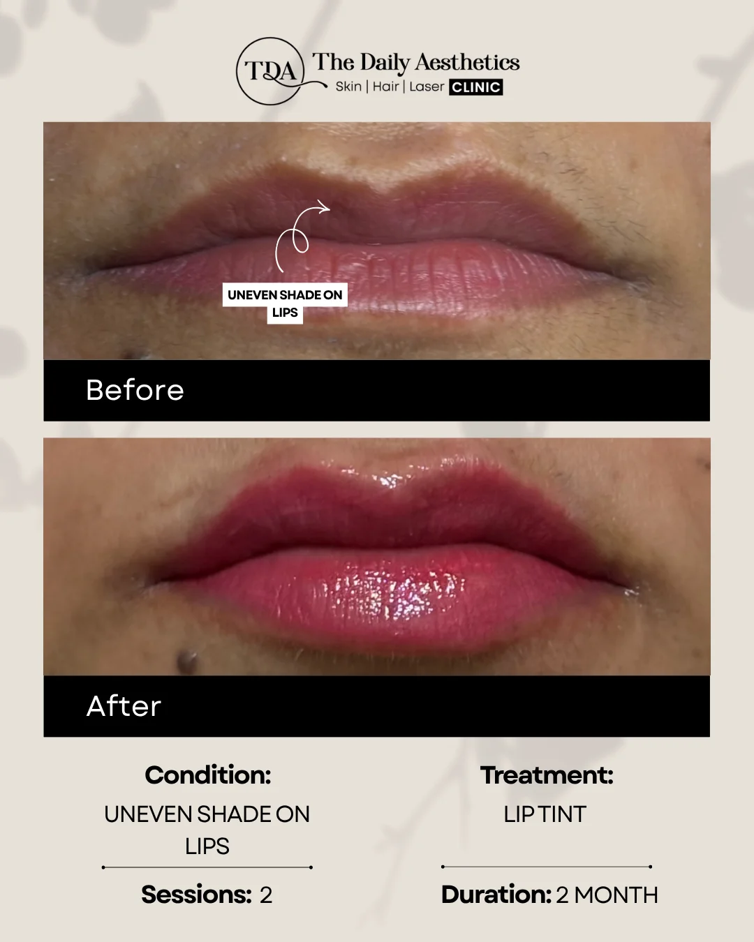 Uneven Shade on Lips (Lip Tint Treatment)