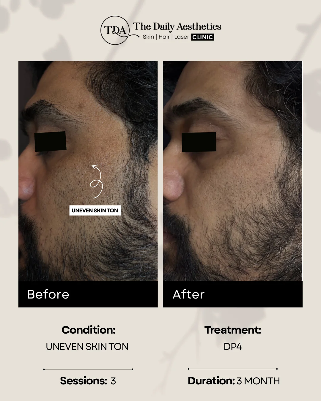 Uneven Skin Tone (DP4 Treatment)