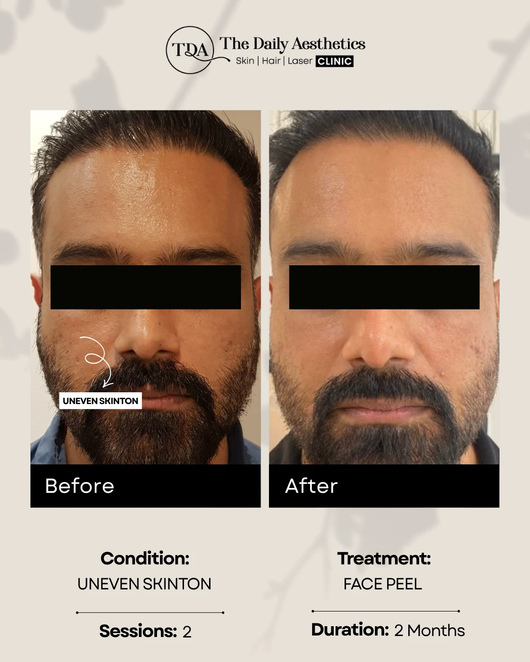 Uneven Skinton (Face Peel Treatment)