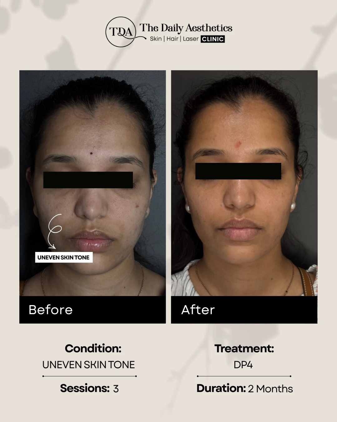 Uneven Skintone (DP4 Treatment)