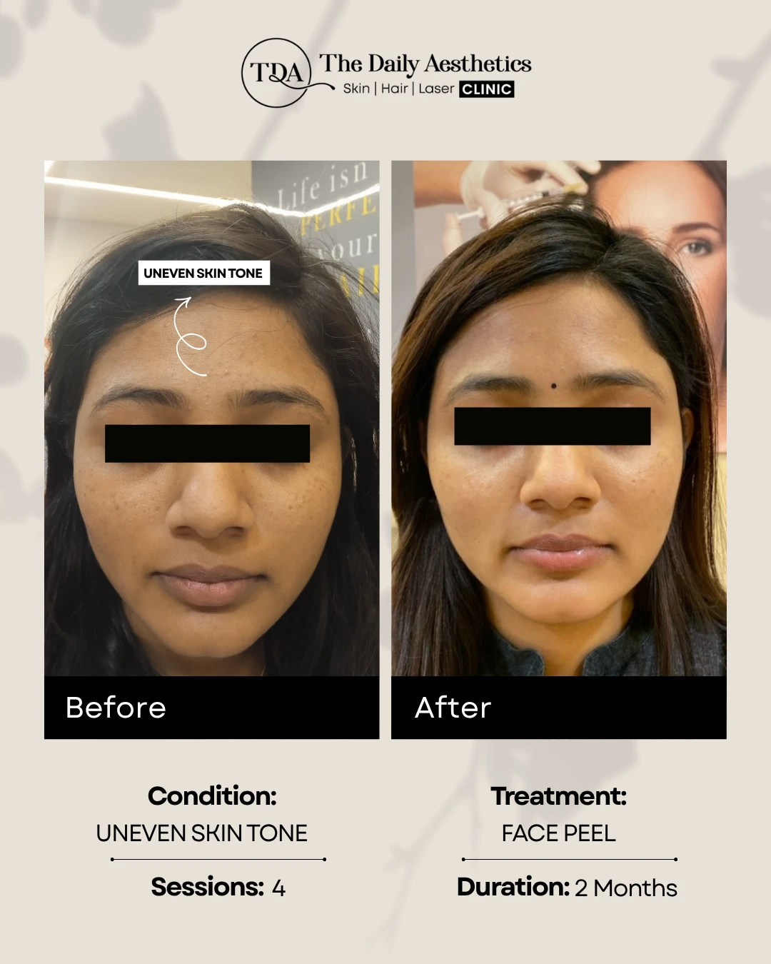 Uneven Skintone (Face Peel Treatment) (2)