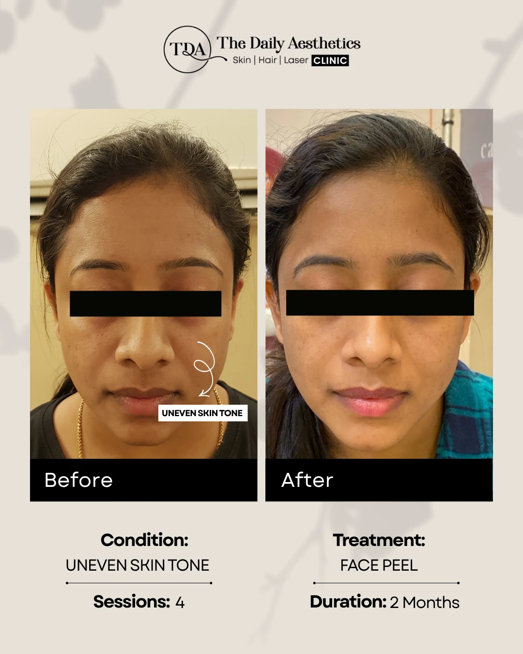 Uneven Skintone (Face Peel Treatment)