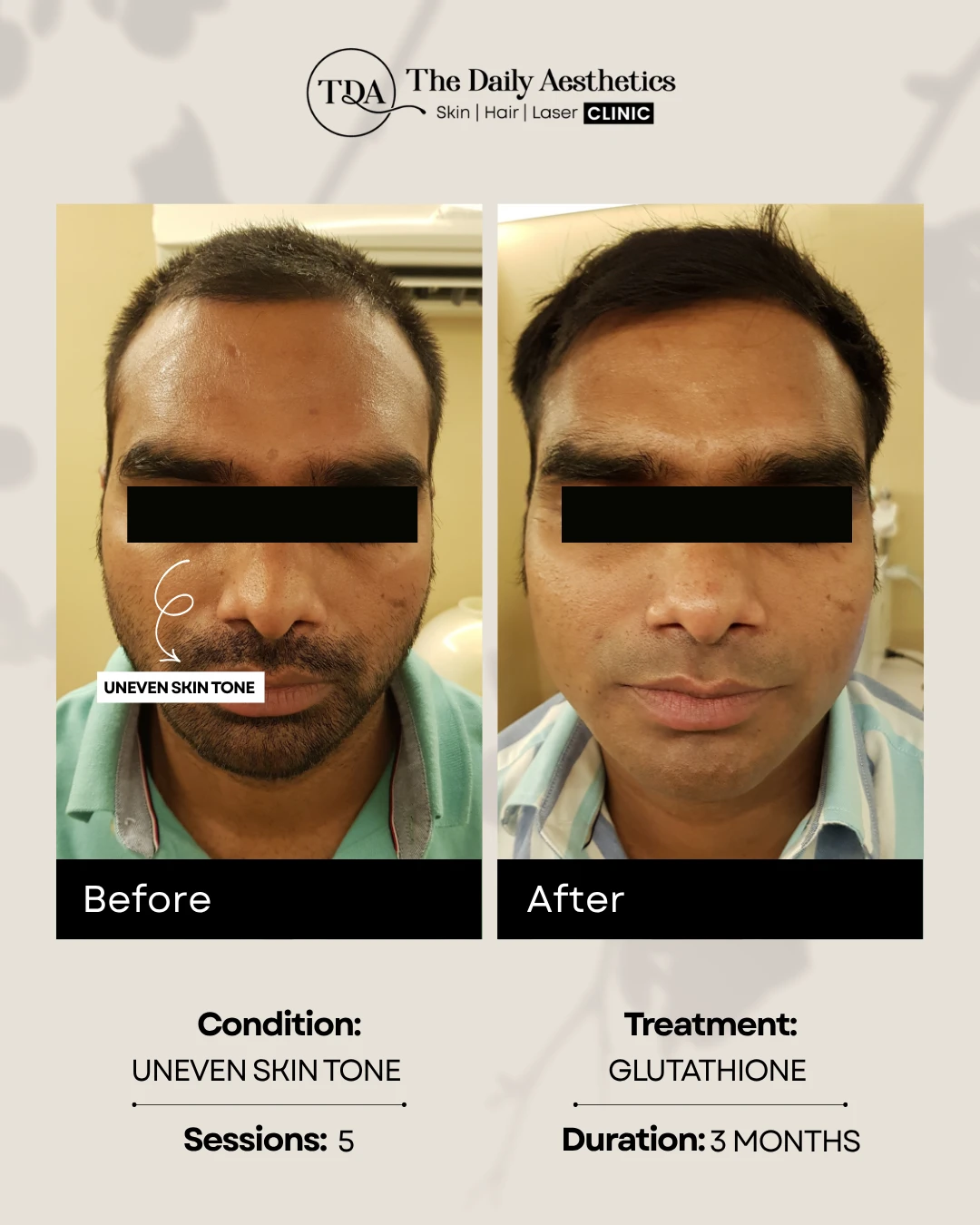 Uneven Skintone (Glutathione)