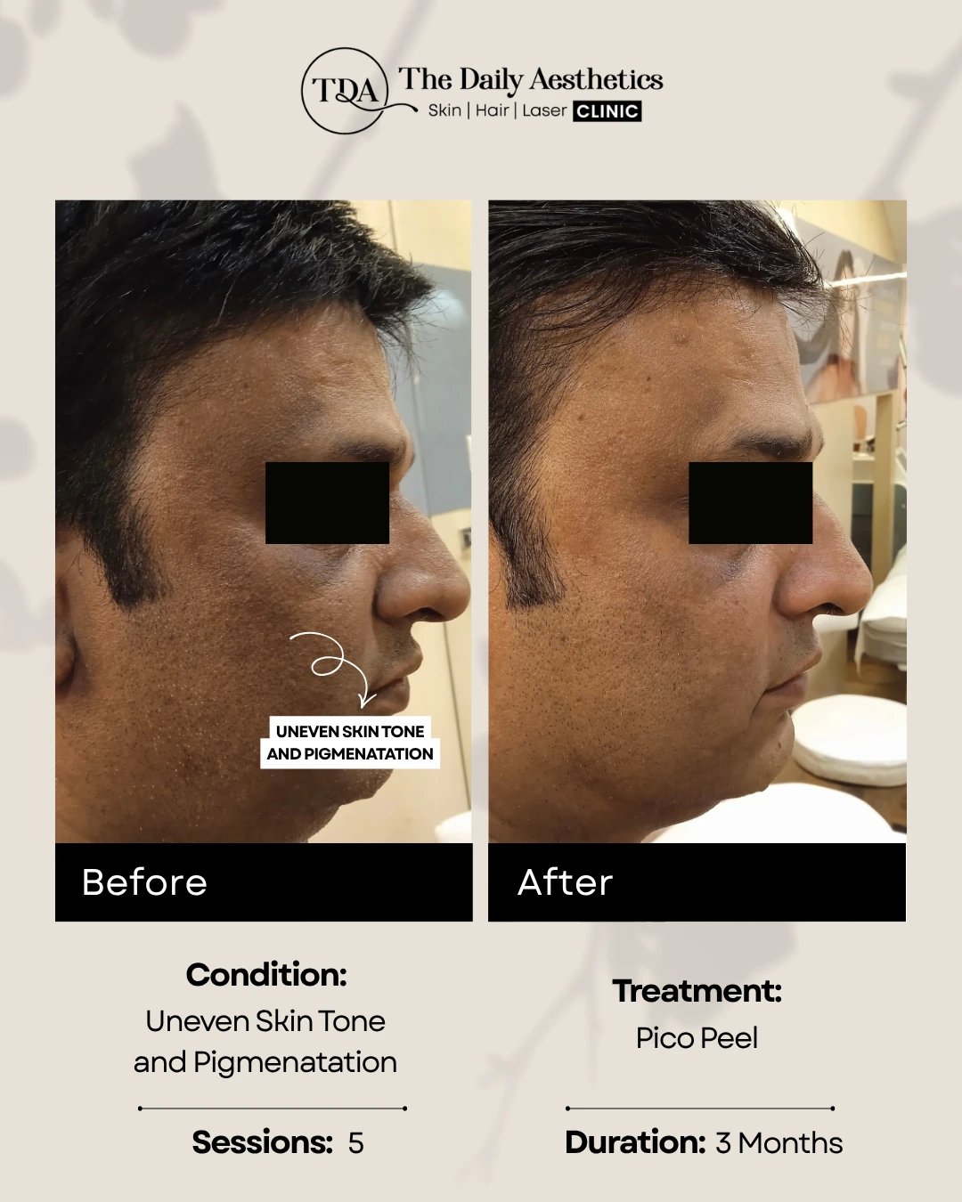 Uneven Skintone and Pigmentation (Pico Peel Treatment)