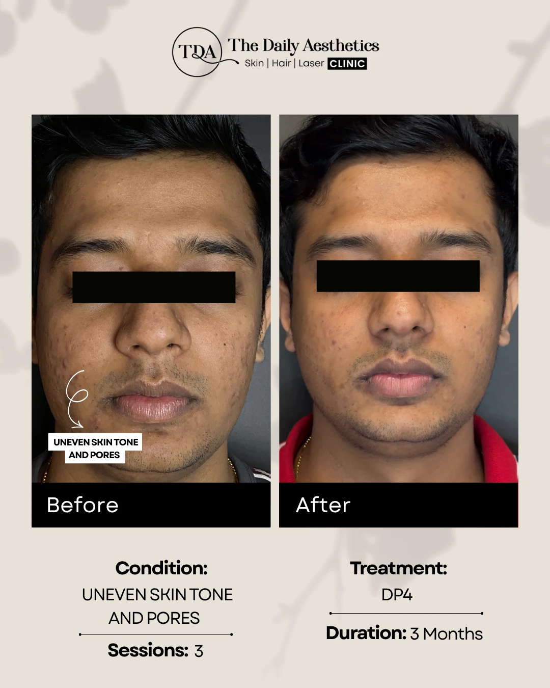Uneven Skintone and Pores (DP4 Treatment)