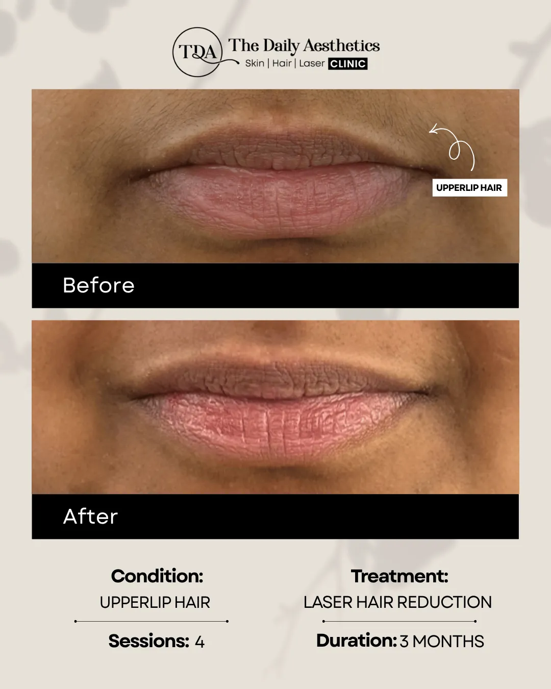 UpperLip Hair (Laser Hair Reduction)