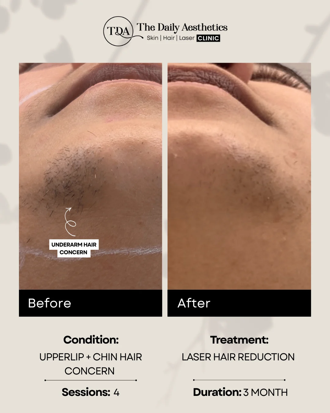 Upperlip + Chin Hair Concern (Laser Hair Reduction Treatment)