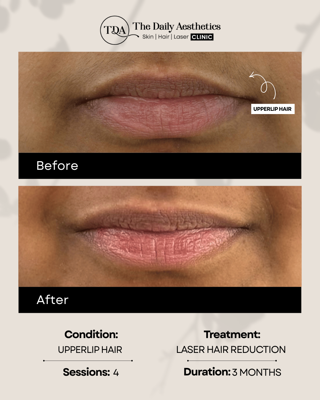 Upperlip Hair (Laser Hair Reduction Treatment)