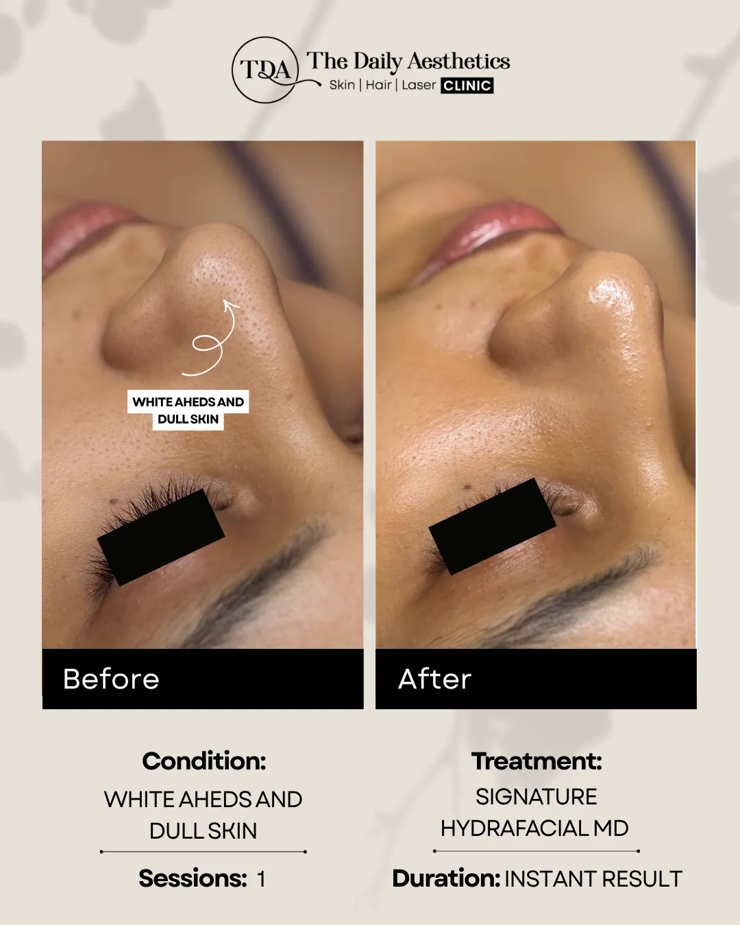 White Aheads And Dull Skin (Signature Hydrafacial MD Treatment)