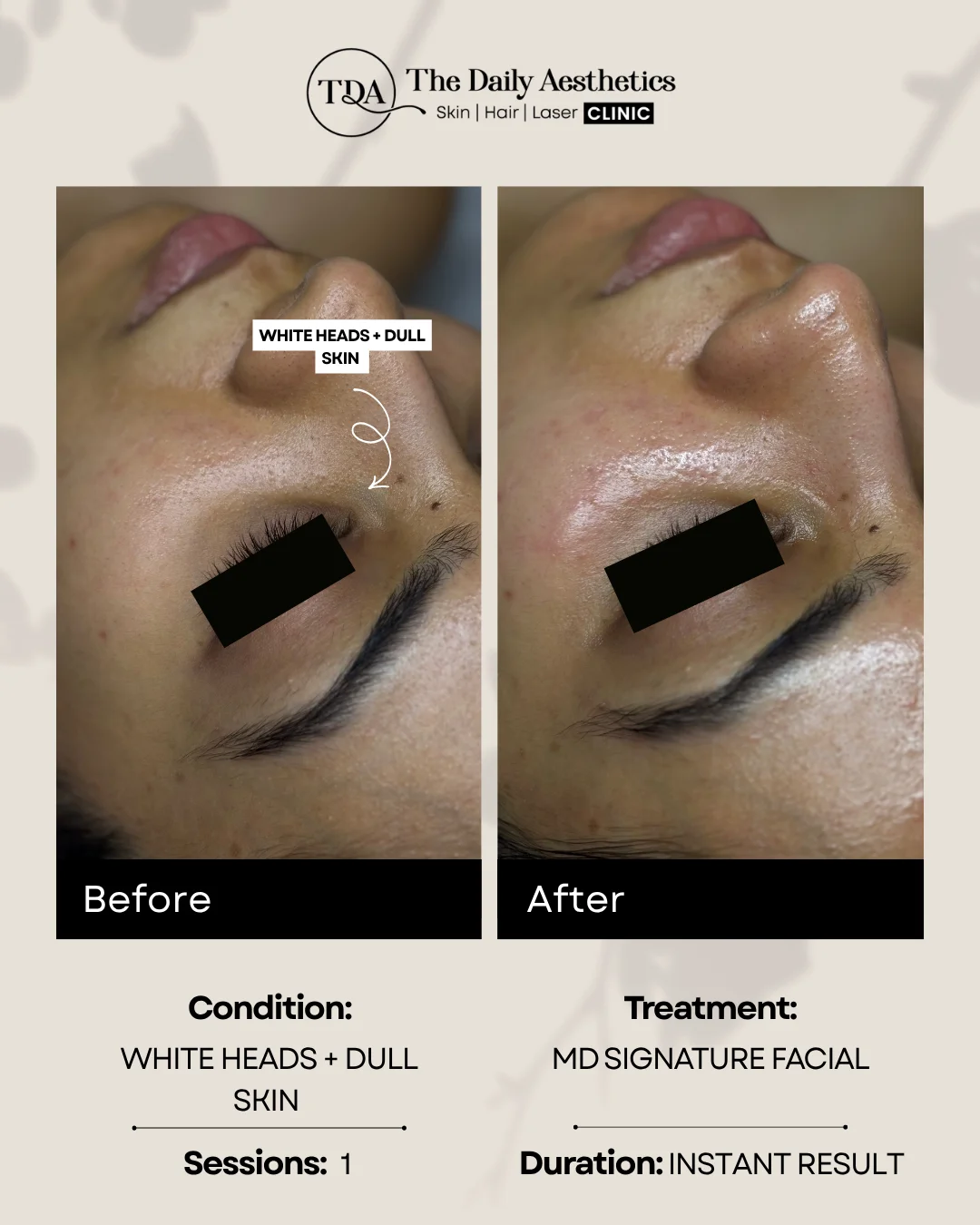 White Heads + Dull SKin (MD Signature Facial Treatment)