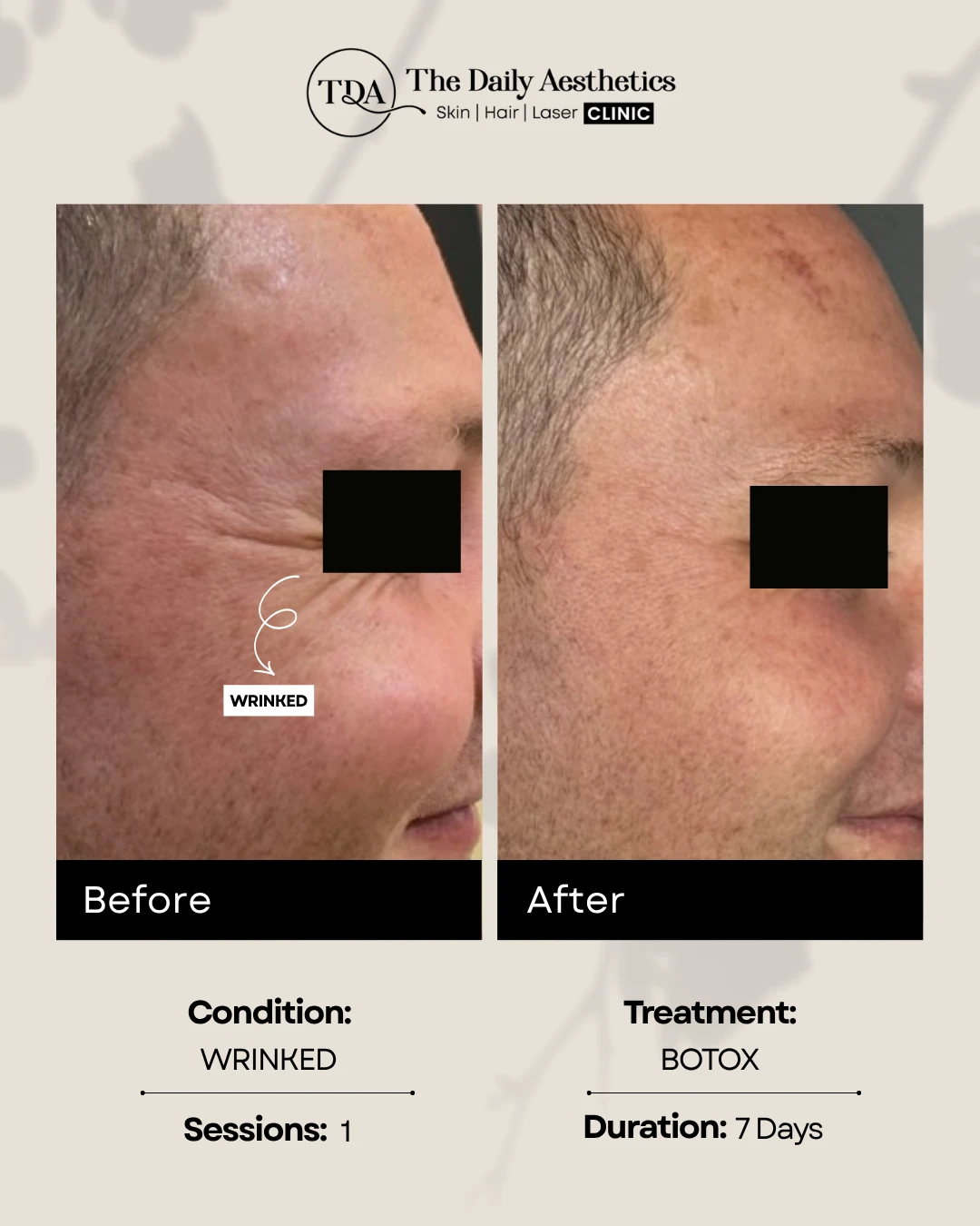 Wrinked (Botox Treatment)