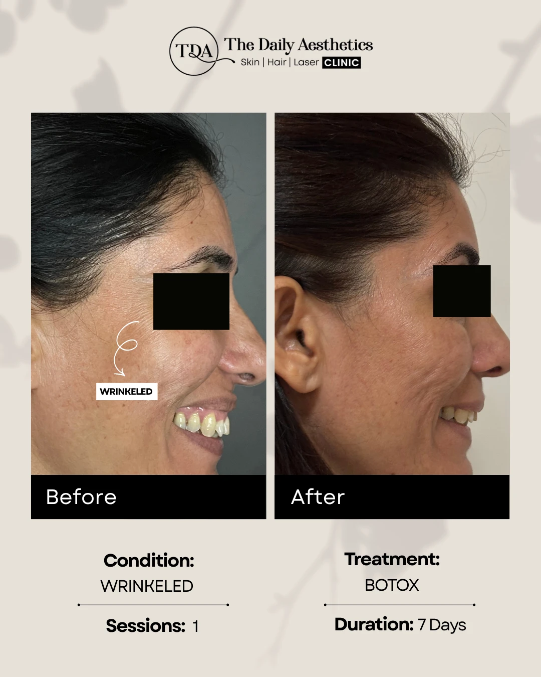 Wrinkeled (Botox Treatment)