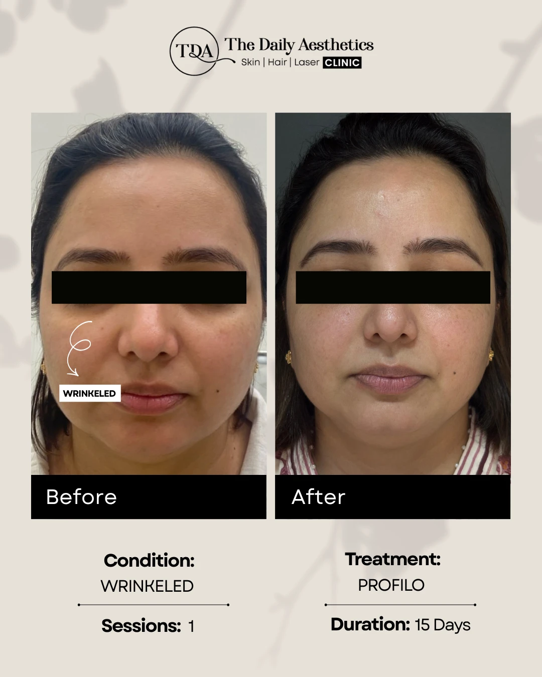 Wrinkeled (Profilo Treatment)