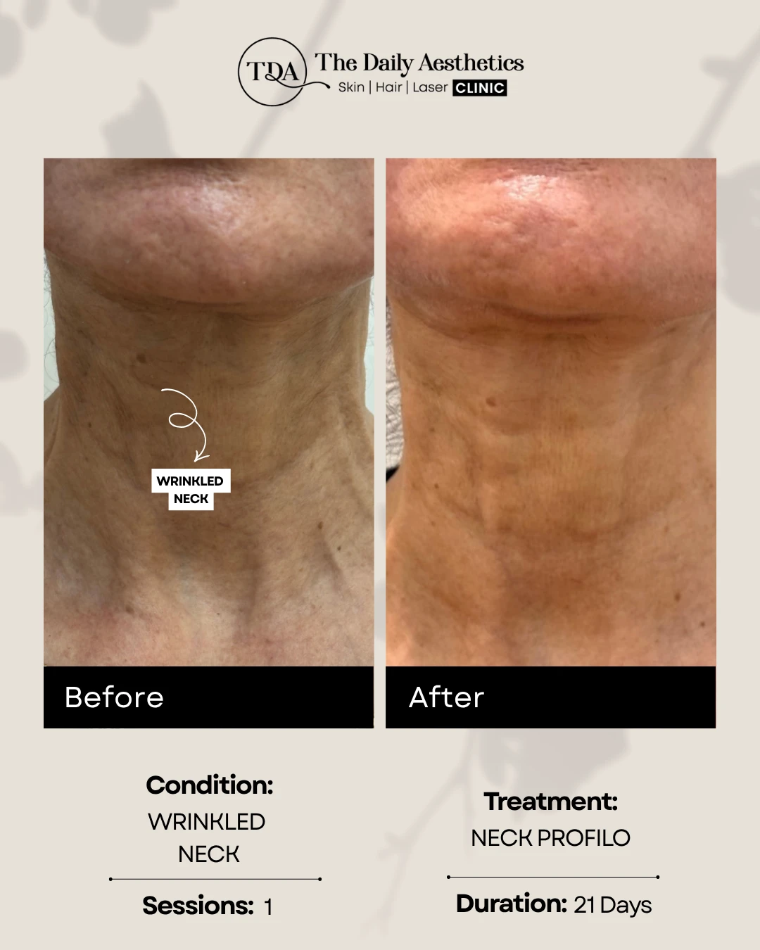 Wrinkled Neck (Neck Profilo Treatment)