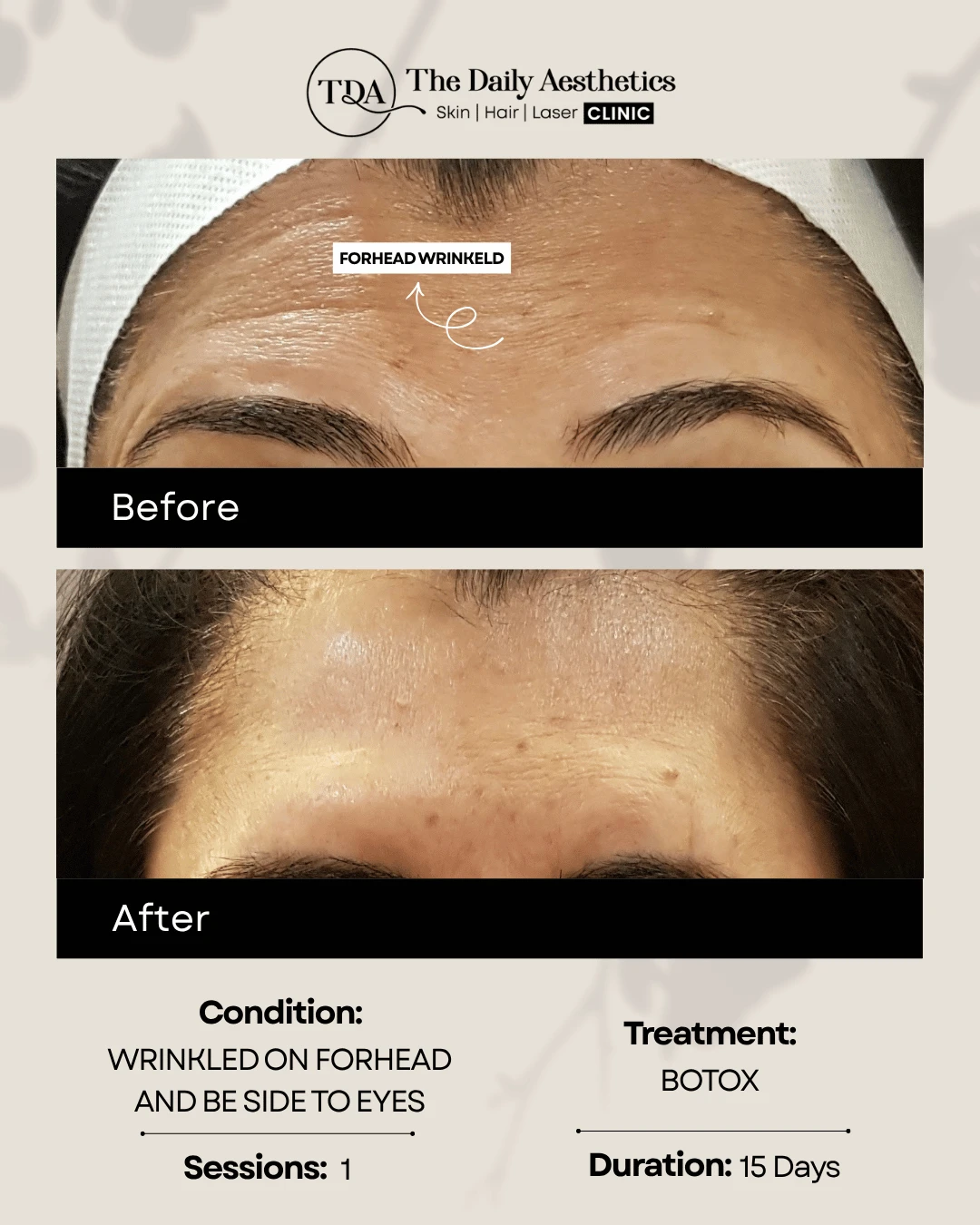 Wrinkled on Forhead & Side to Eyes (Botox Treatment)