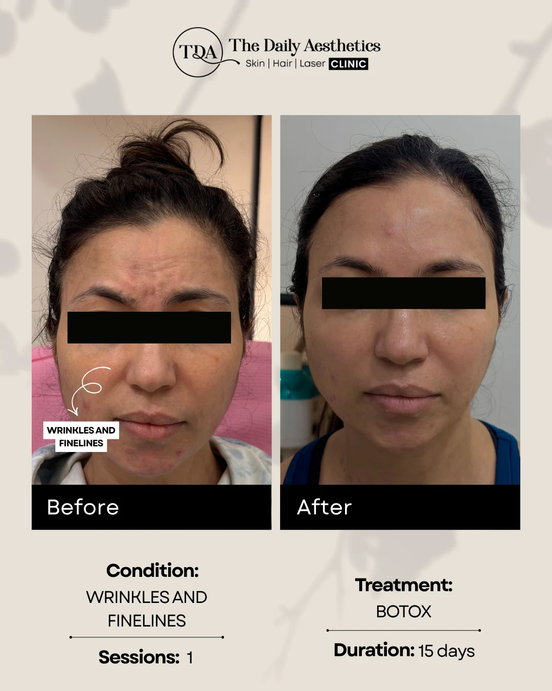 Wrinkles and Finelines (Botox Treatment)