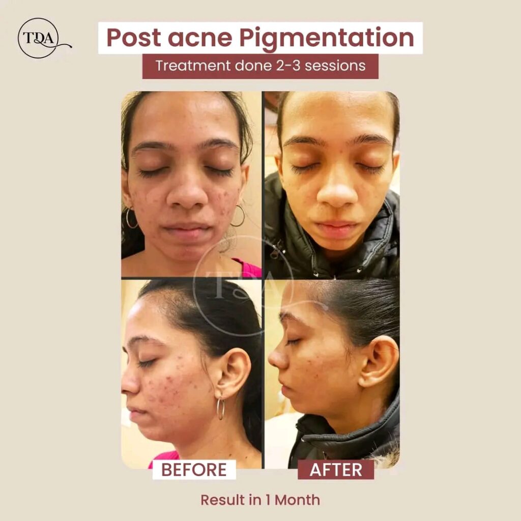 Pigmentation Treatment in Vasant Vihar