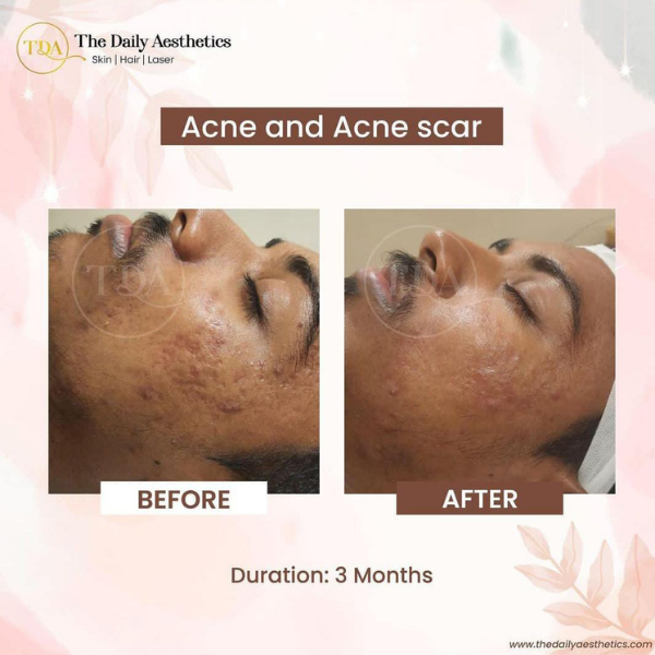 Female Hair Loss Treatment In Kharadi