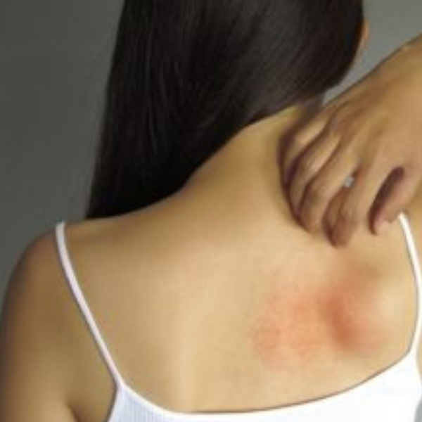 Skin Allergy Treatment in Magarpatta