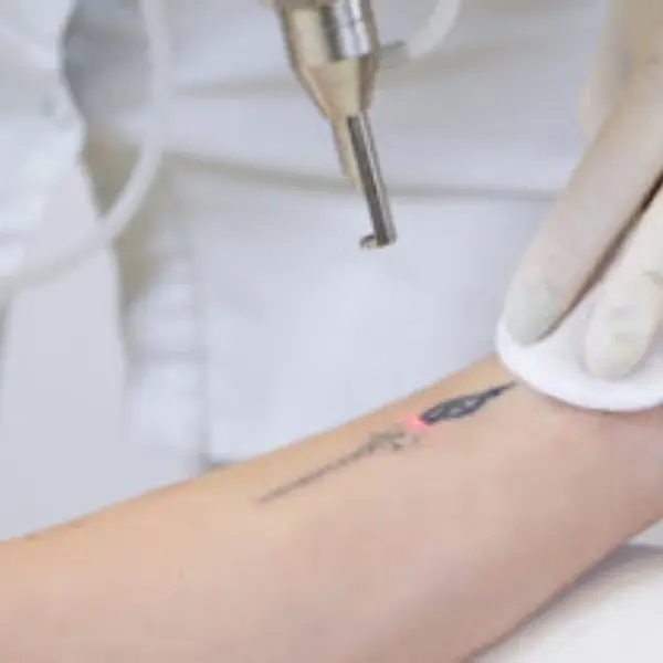 Tattoo Removal Treatment in Pune
