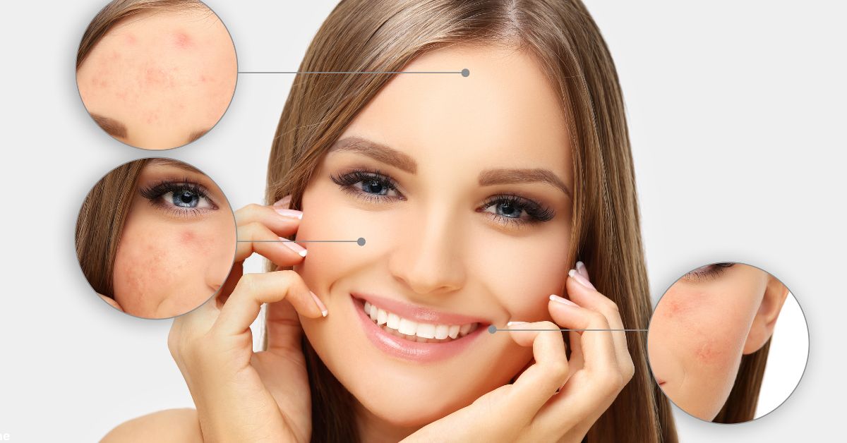 Acne Scar Treatment in Pune