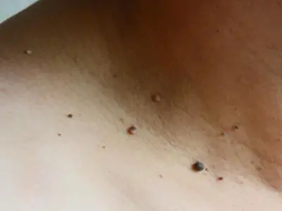 Skin Tag Removal Pune