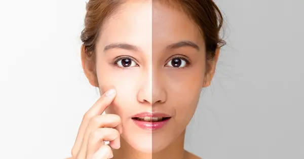 Skin Whitening Treatment In Pune