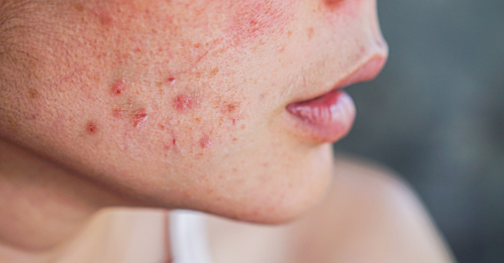 Acne Scar Treatment in Kharadi