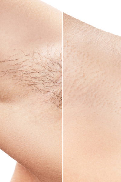 Laser Hair Removal