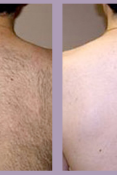 Laser Hair Removal