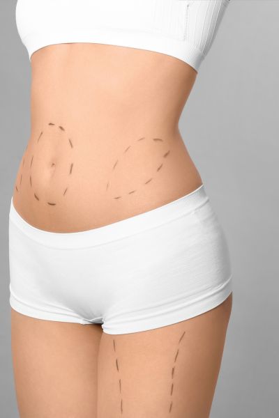 Non Surgical Tummy Tuck