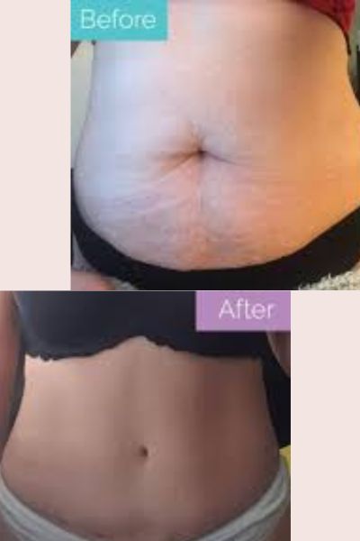 Non Surgical tummy tuck treatment kharadi