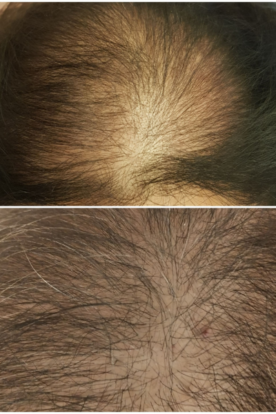 Hair Transplant