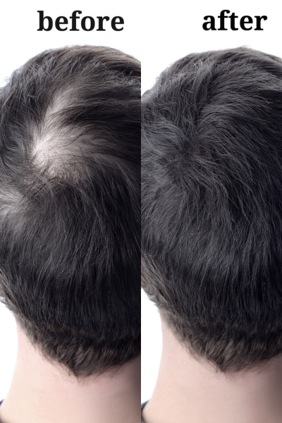 Hair Transplant