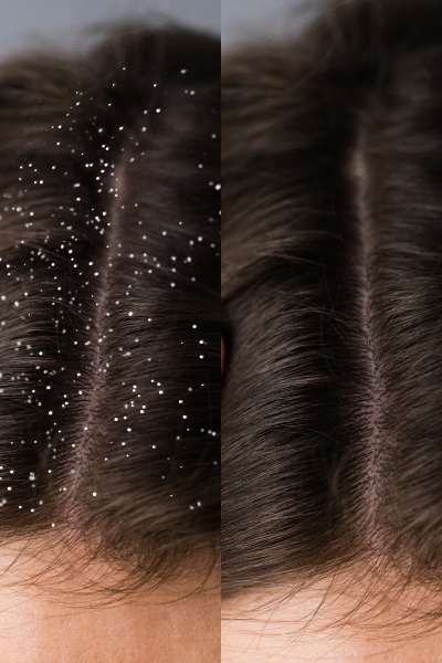 dandruff treatment