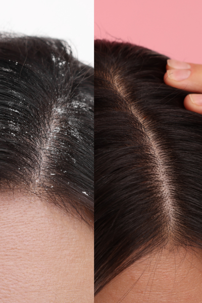 Dandruff Treatment