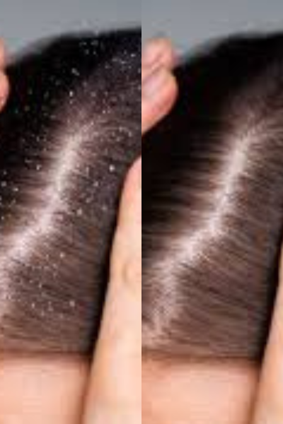 Dandruff Treatment