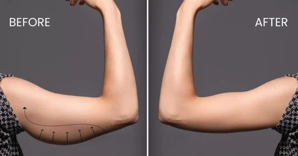 Arm Contering