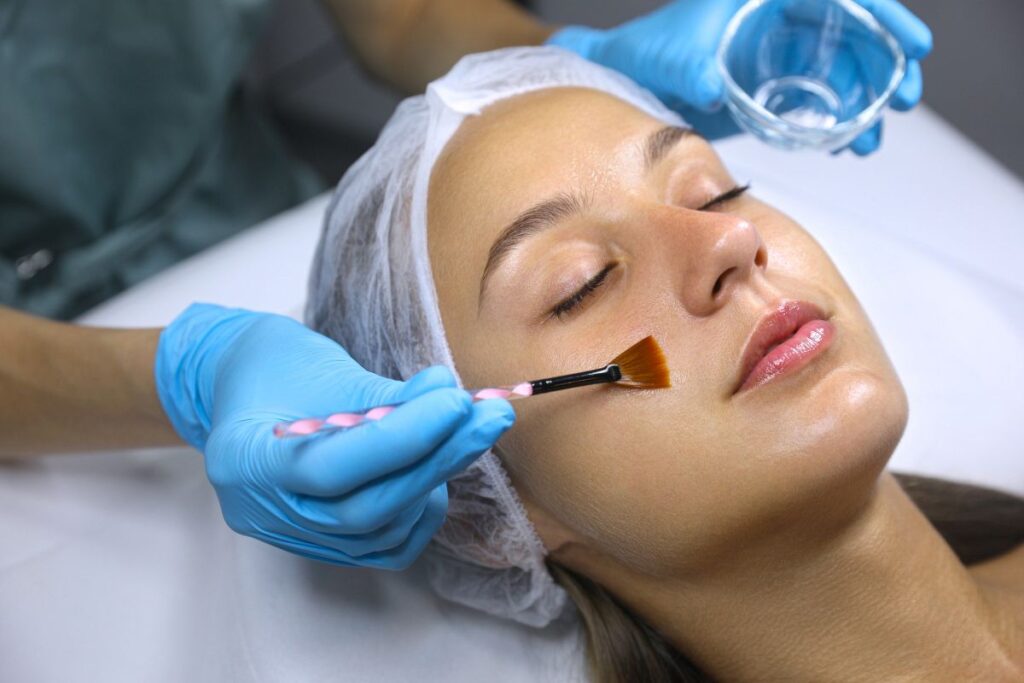 Chemical Peel